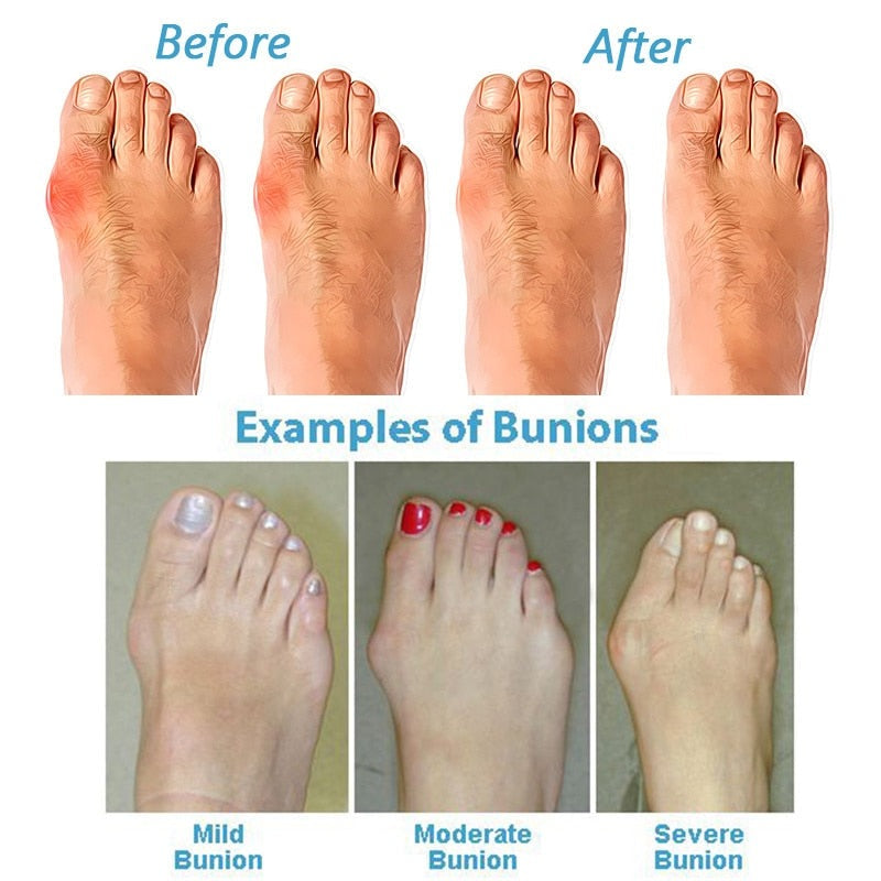 OrthoSandels - Orthopedic & Corrective Sandals for Bunions